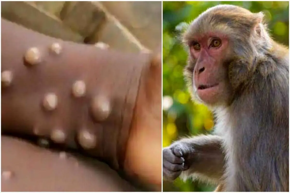 ثبت اولین مرگ ناشی از آبله میمون در ژاپن