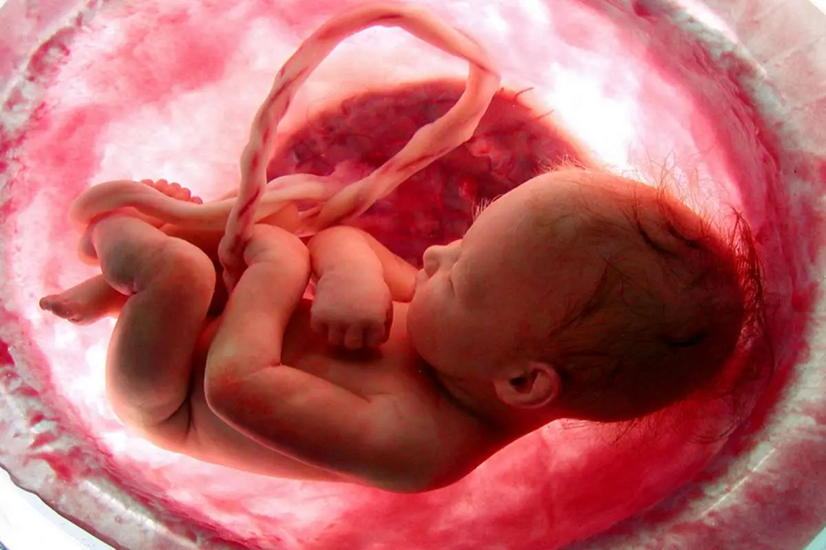 شناسایی و سقط 13 جنین معلول در همدان