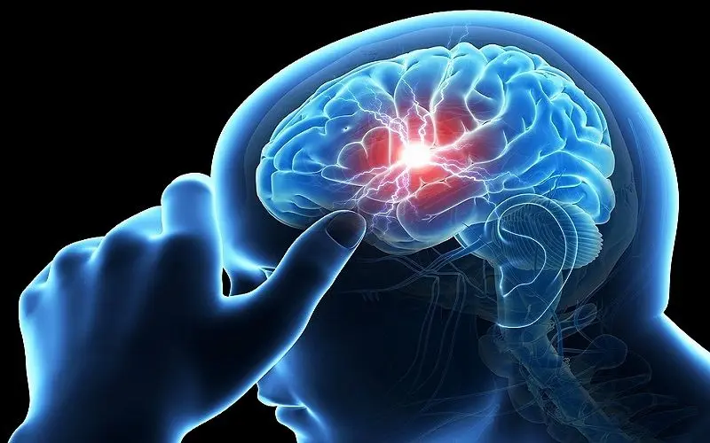 مردان بیش از زنان به سکته مغزی مبتلا می‌شوند
