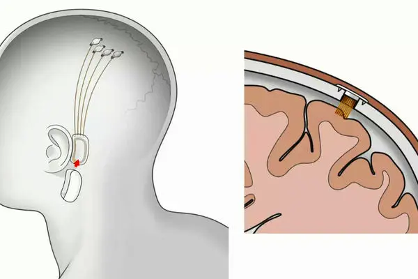 شرکت نورالینک ایلان ماسک؛ آغازی برای دنیای بدون گوشی‌های هوشمند