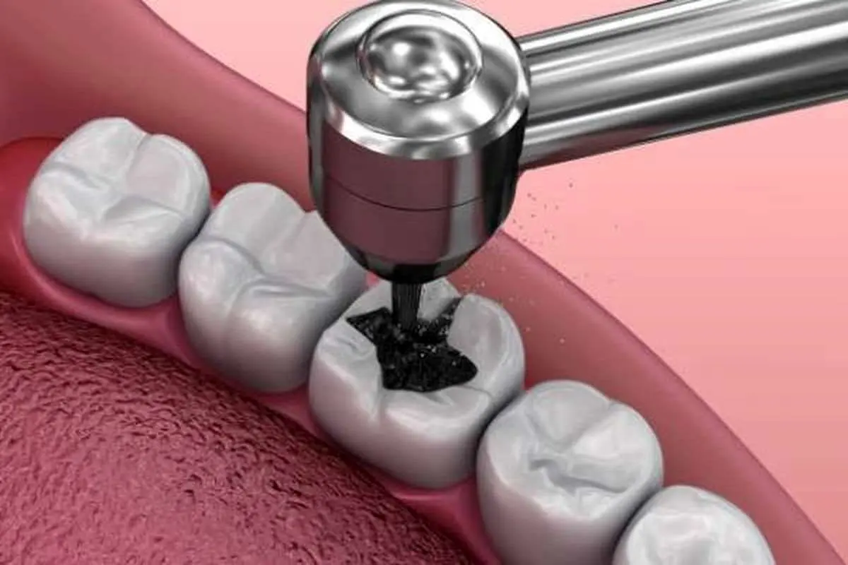 تفاوت عصب کشی دندان و پرکردن دندان چیست؟