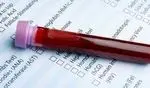 شناسایی ۳ نوع سرطان با یک قطره خون 